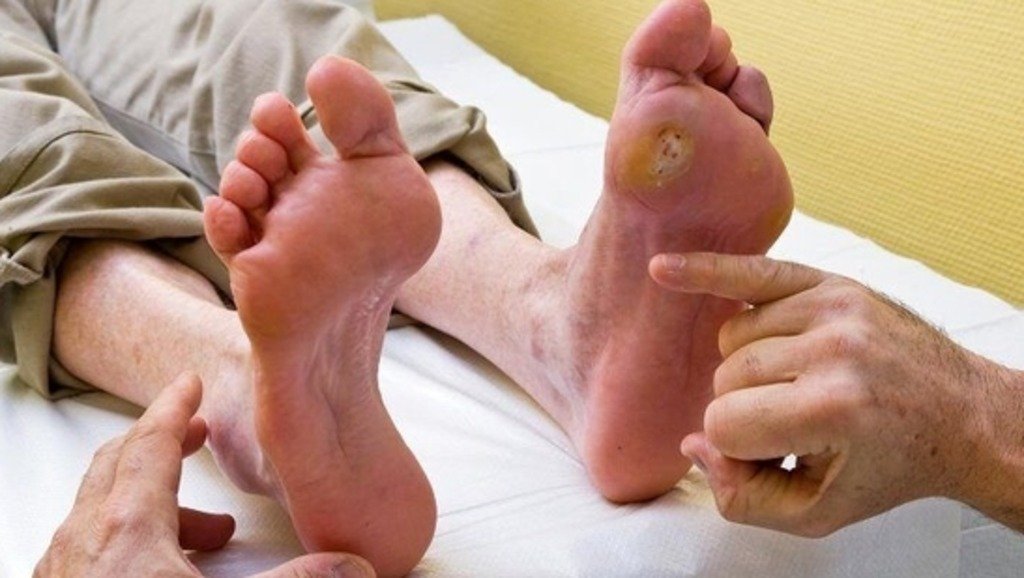 Diabetic Foot ulcer Treatement
