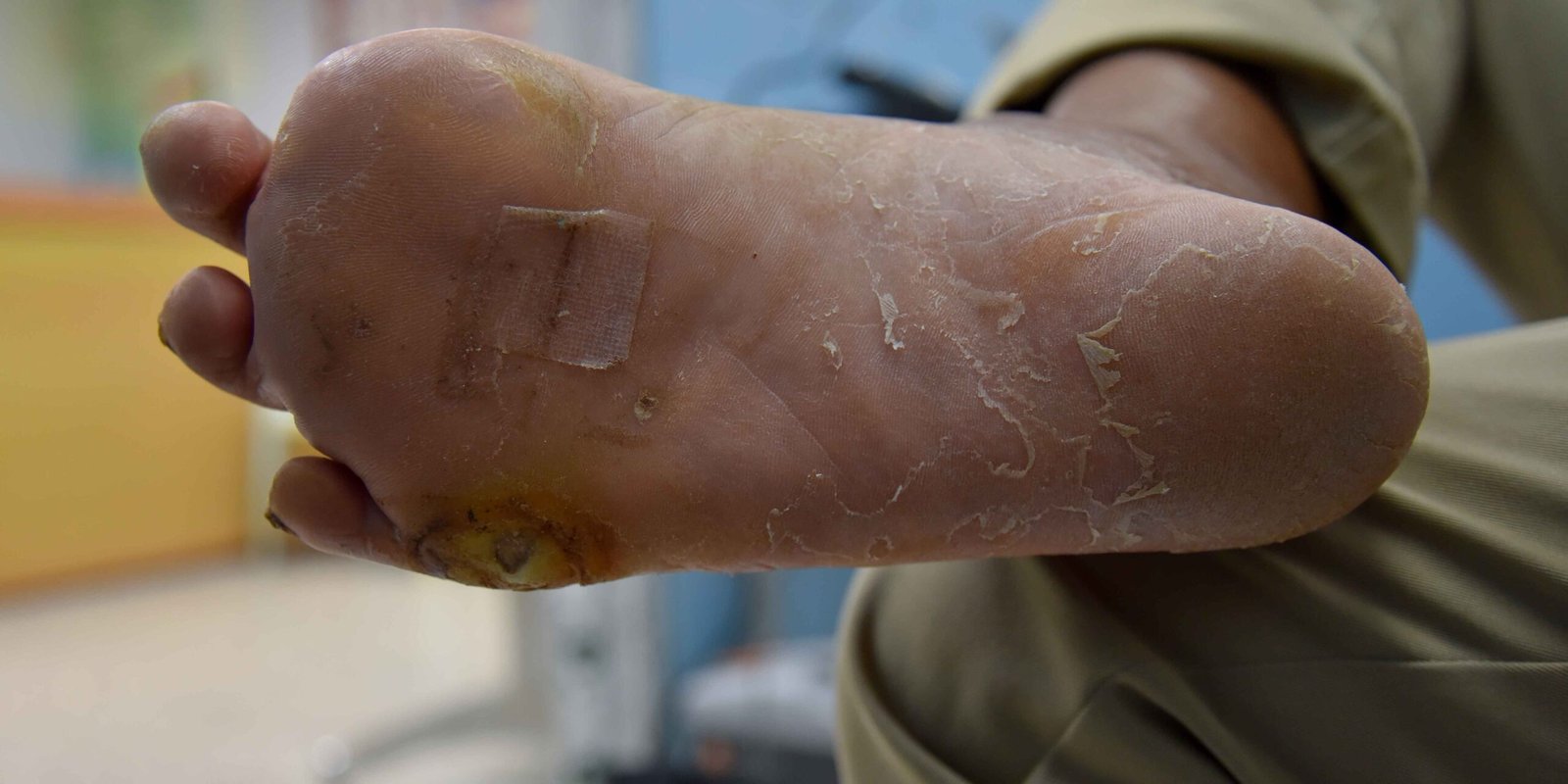 Diabetic Foot Ulcer