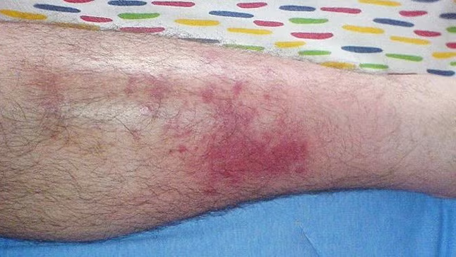 deep tissue infection