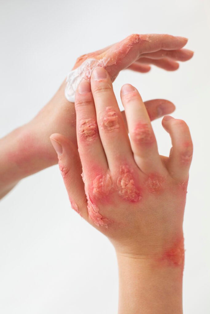 burn wound