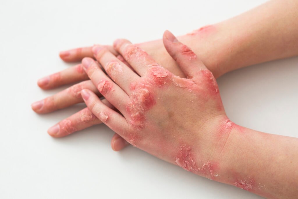 burn infected wound