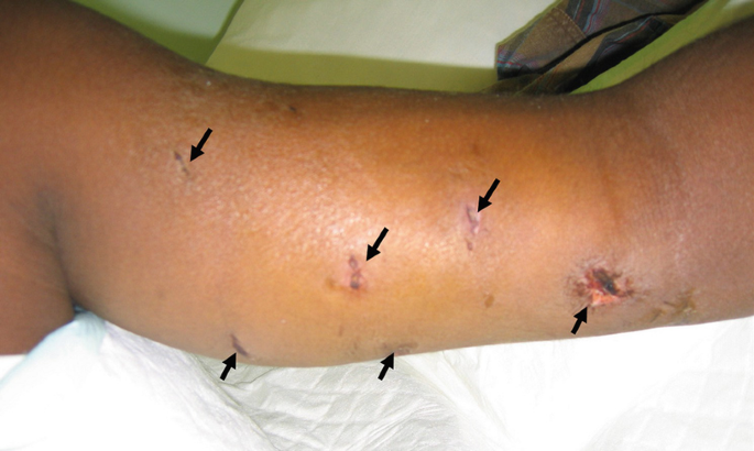 Dog Bite wound