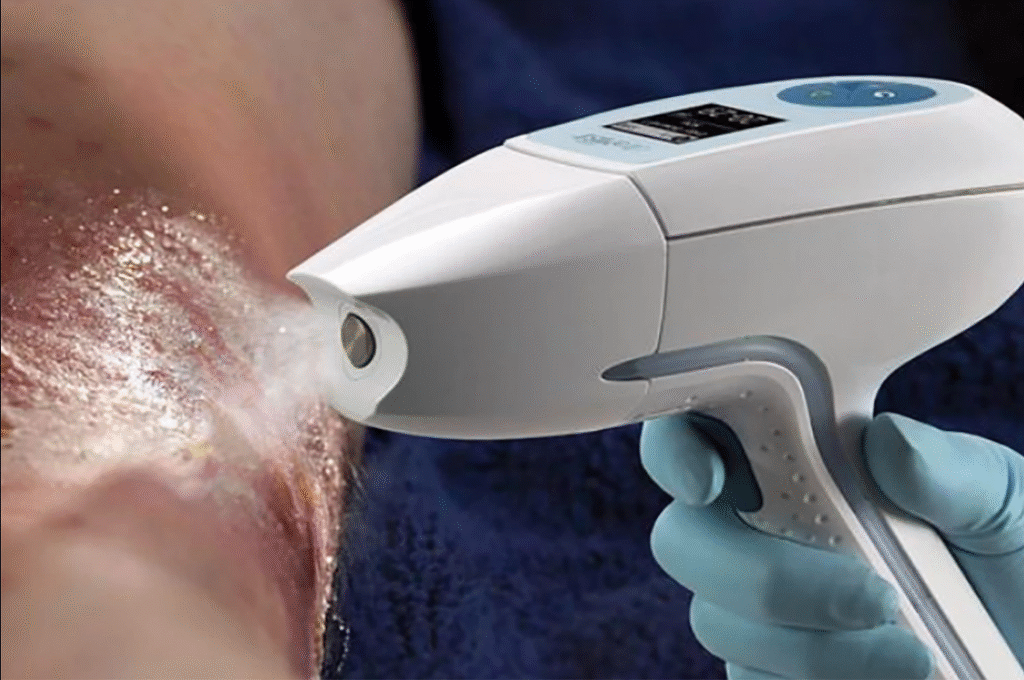 Ultramist Wound Therapy