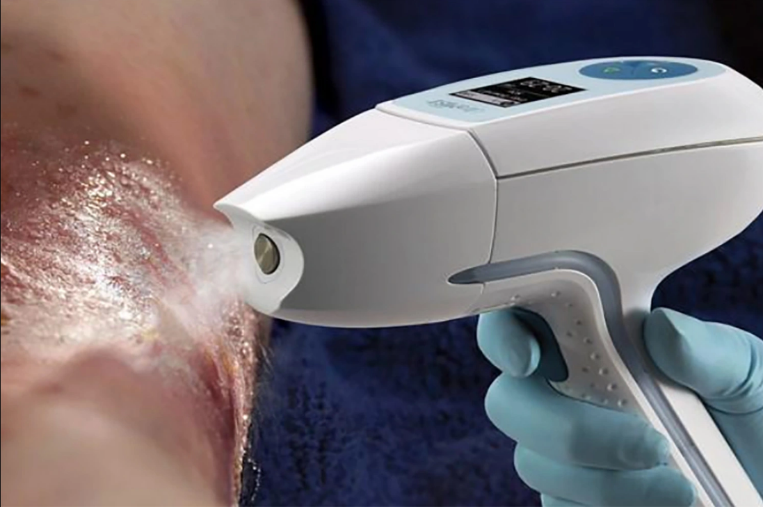 Ultramist Wound Therapy