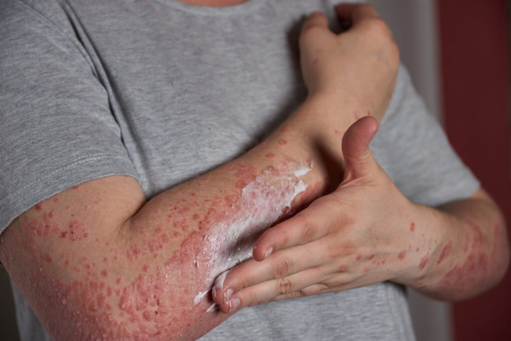 Soft Tissue Infections