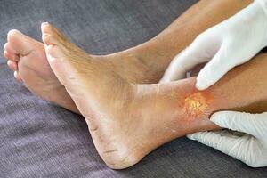 diabetic traumatic wound
