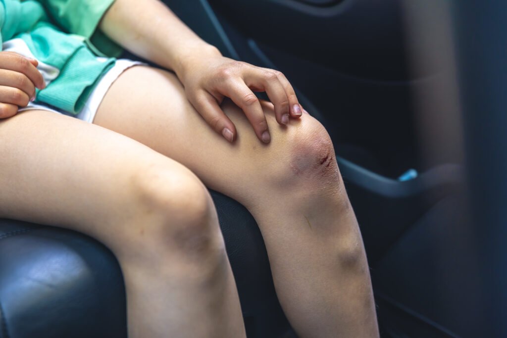 Road Rash Wounds